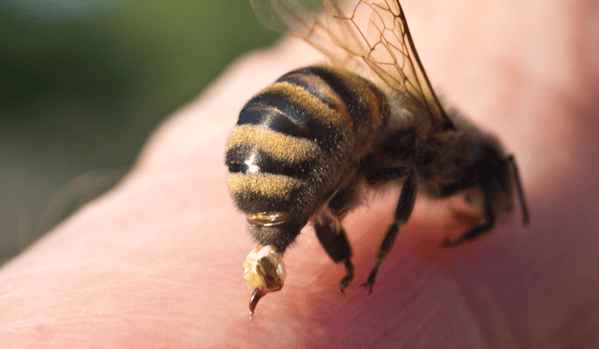 Abeja obrera picando la piel de una persona